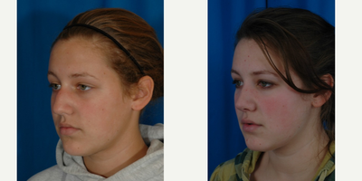 Rhinoplasty before and after photo