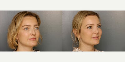 Rhinoplasty before and after photo