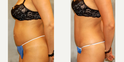 Tummy Tuck before and after photo