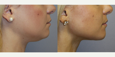 Chin Liposuction before and after photo