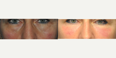 Eyelid Surgery before and after photo