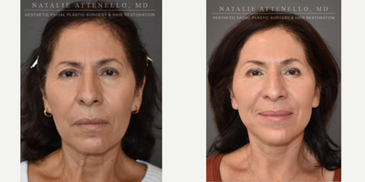Eyelid Surgery before and after photo