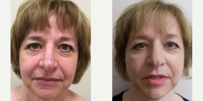 Facelift before and after photo