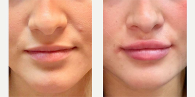 Juvederm before and after photo