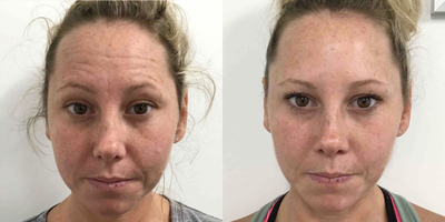 Botox before and after photo