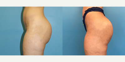 Brazilian Butt Lift before and after photo