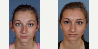 Ear Surgery before and after photo