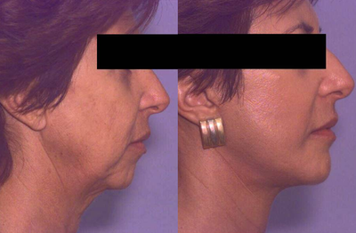 Neck Lift before and after photo