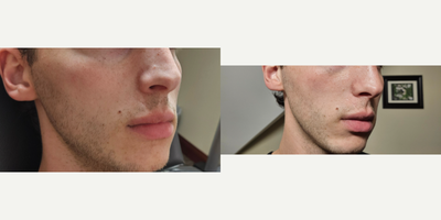 Restylane before and after photo