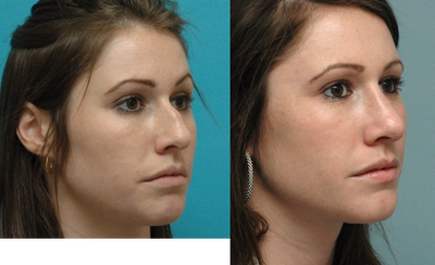 Septoplasty before and after photo
