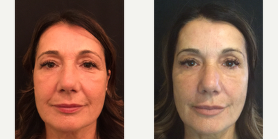 Dermal Fillers before and after photo