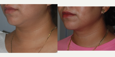 Liposuction before and after photo