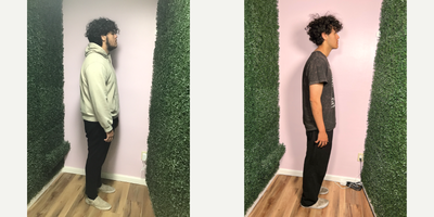 Orbera Gastric Balloon before and after photo