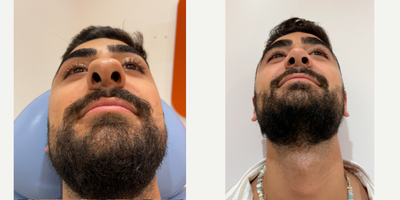 Septoplasty before and after photo