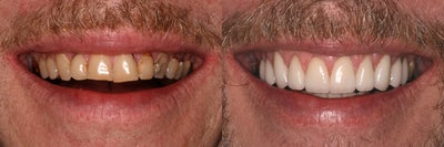 Smile Makeover before and after photo