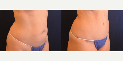 Tummy Tuck before and after photo