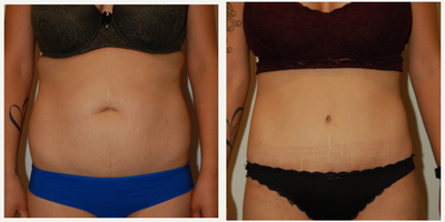 Tummy Tuck before and after photo