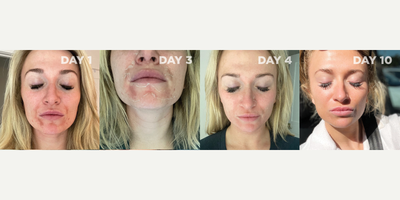 Chemical Peel before and after photo