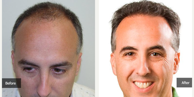 Hair Loss Treatment before and after photo