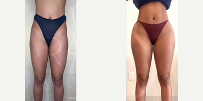 Hip Implants before and after photo