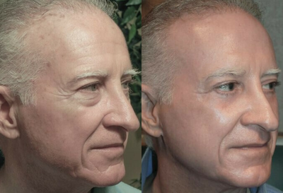 Laser Resurfacing before and after photo