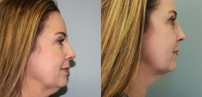 Microneedling before and after photo