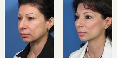 Facelift before and after photo