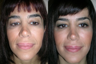 Lip Reduction before and after photo