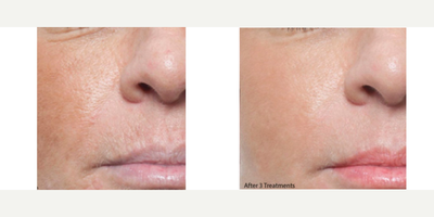 Microneedling RF before and after photo