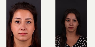 Revision Rhinoplasty before and after photo