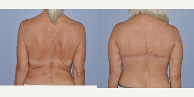 Body Lift before and after photo