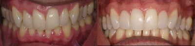 Dental Bonding before and after photo