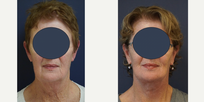 Facelift before and after photo