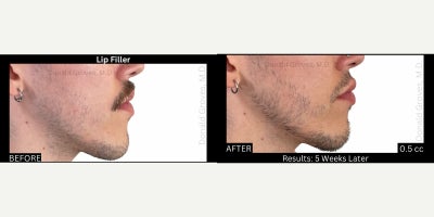 Restylane before and after photo