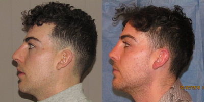 Revision Rhinoplasty before and after photo