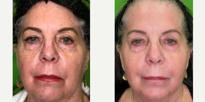 Skin Rejuvenation before and after photo