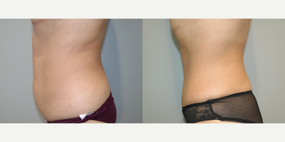 Tummy Tuck before and after photo