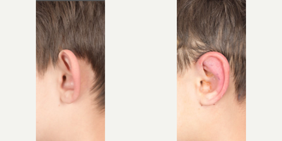 Ear Surgery before and after photo