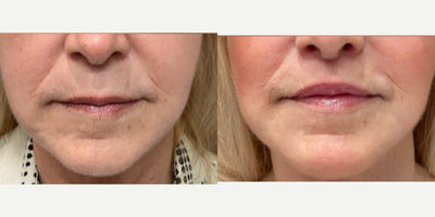 Lip Lift before and after photo