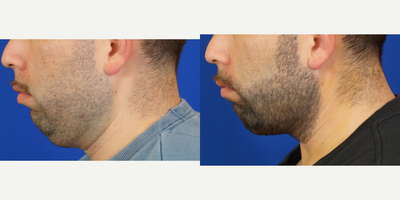 Neck Lift before and after photo