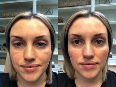 Voluma before and after photo