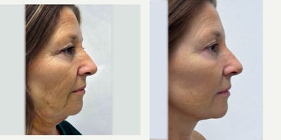 Facelift before and after photo