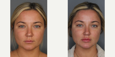 Juvederm before and after photo