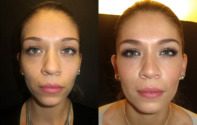 Radiesse before and after photo