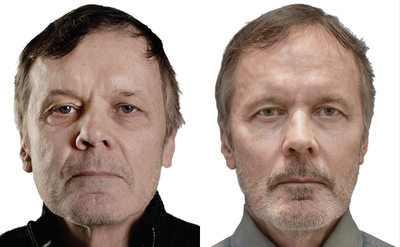 Restylane Defyne before and after photo
