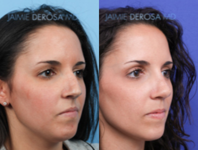 Revision Rhinoplasty before and after photo