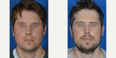 Revision Rhinoplasty before and after photo