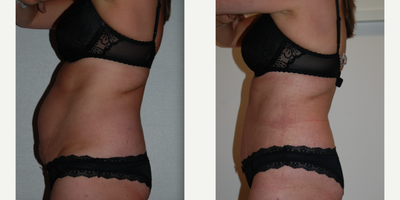 Tummy Tuck before and after photo