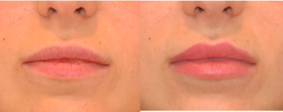 Belotero before and after photo