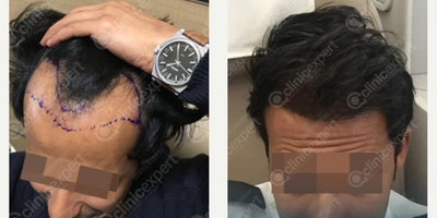 Hair Loss Treatment before and after photo